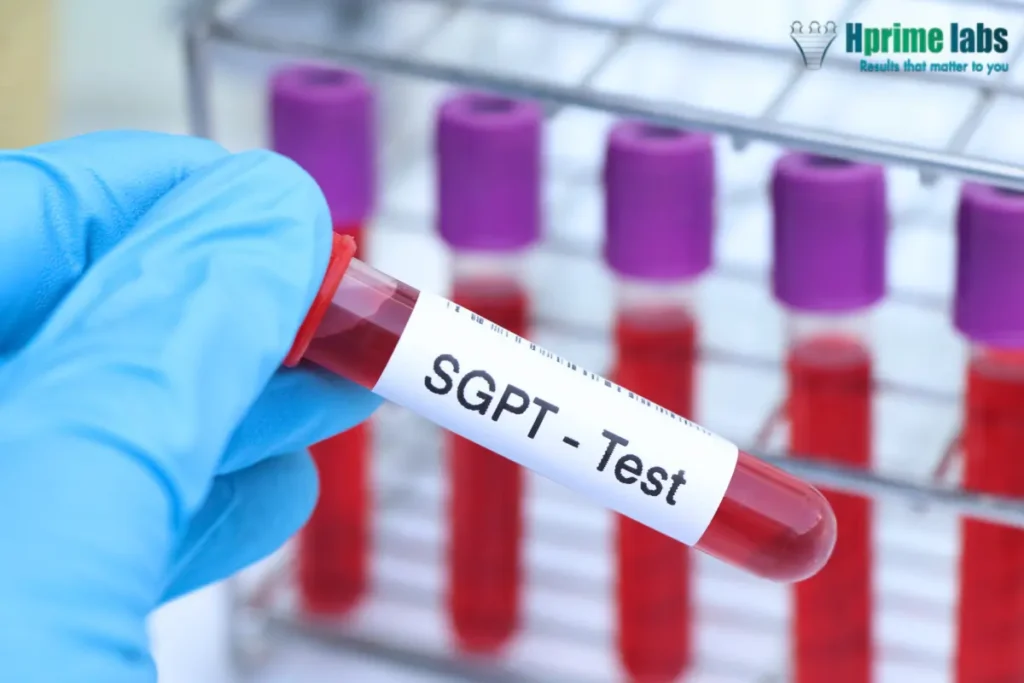 SGPT (Serum Glutamic Pyruvic Transaminase) test